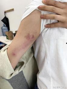 手臂受伤图片,紧急处理与康复指南